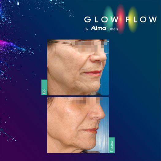 Glow Flow фирменная процедура